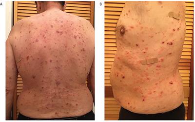 Case report: Documentation of cutaneous only pemphigus vulgaris without history of mucosal lesions in North America